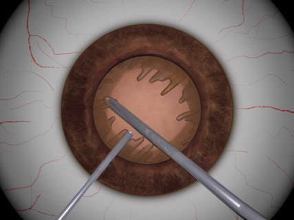 Cortical Removal With Split Irrigation