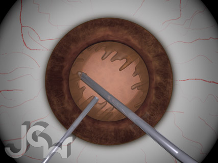 Cortical Removal With Split Irrigation