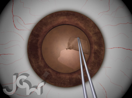 Capsulorhexis With Forceps
